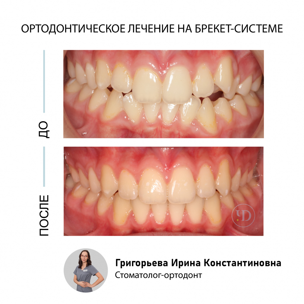 Ортодонтическое лечение на брекет-системе Damon Q