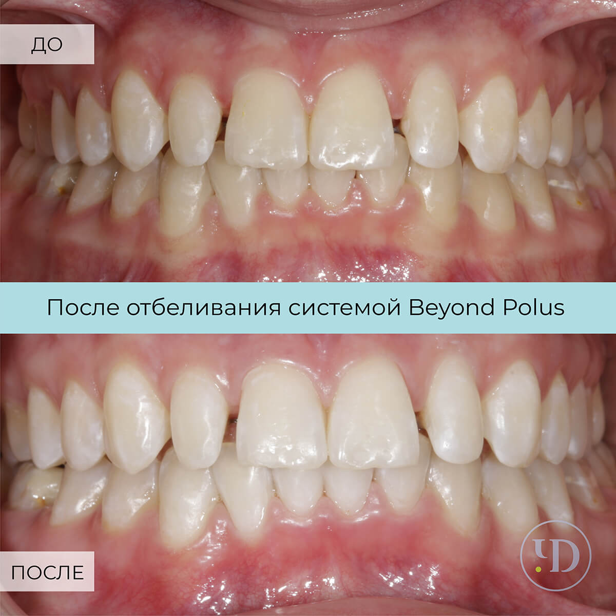 Кейс отбеливания Бейонд Полюс — Стоматологические центры Чистое Дыхание в  СПб