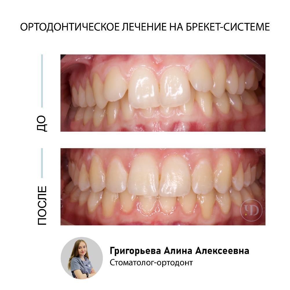 Гингивопластика или пластика десны : фото до и после | Стоматология в СПб  «Чистое Дыхание»