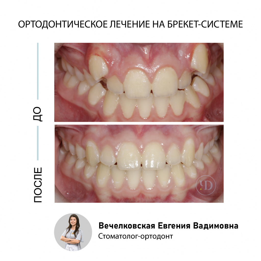 Ортодонтическое лечение на брекет-системе Damon Q