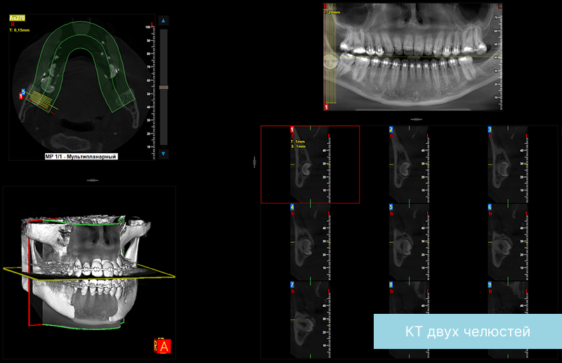 Рентген зуба: показания и особенности диагностики