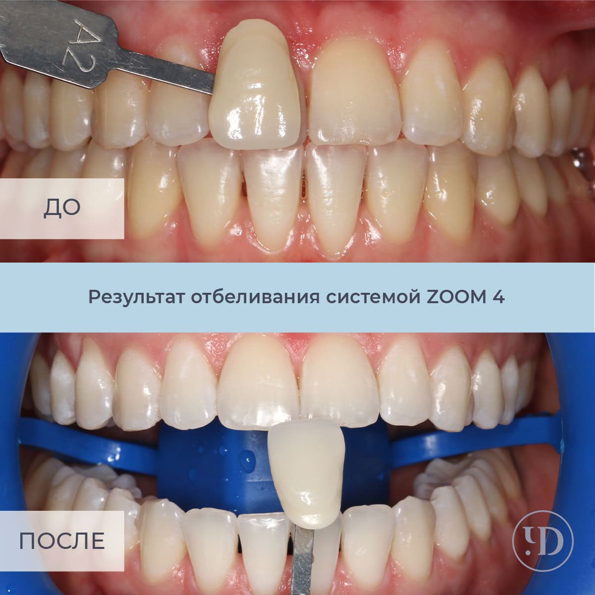 Отбеливание зубов в СПб в стоматологиях Чистое Дыхание - Цены на  отбеливание зубов в Санкт-Петербурге