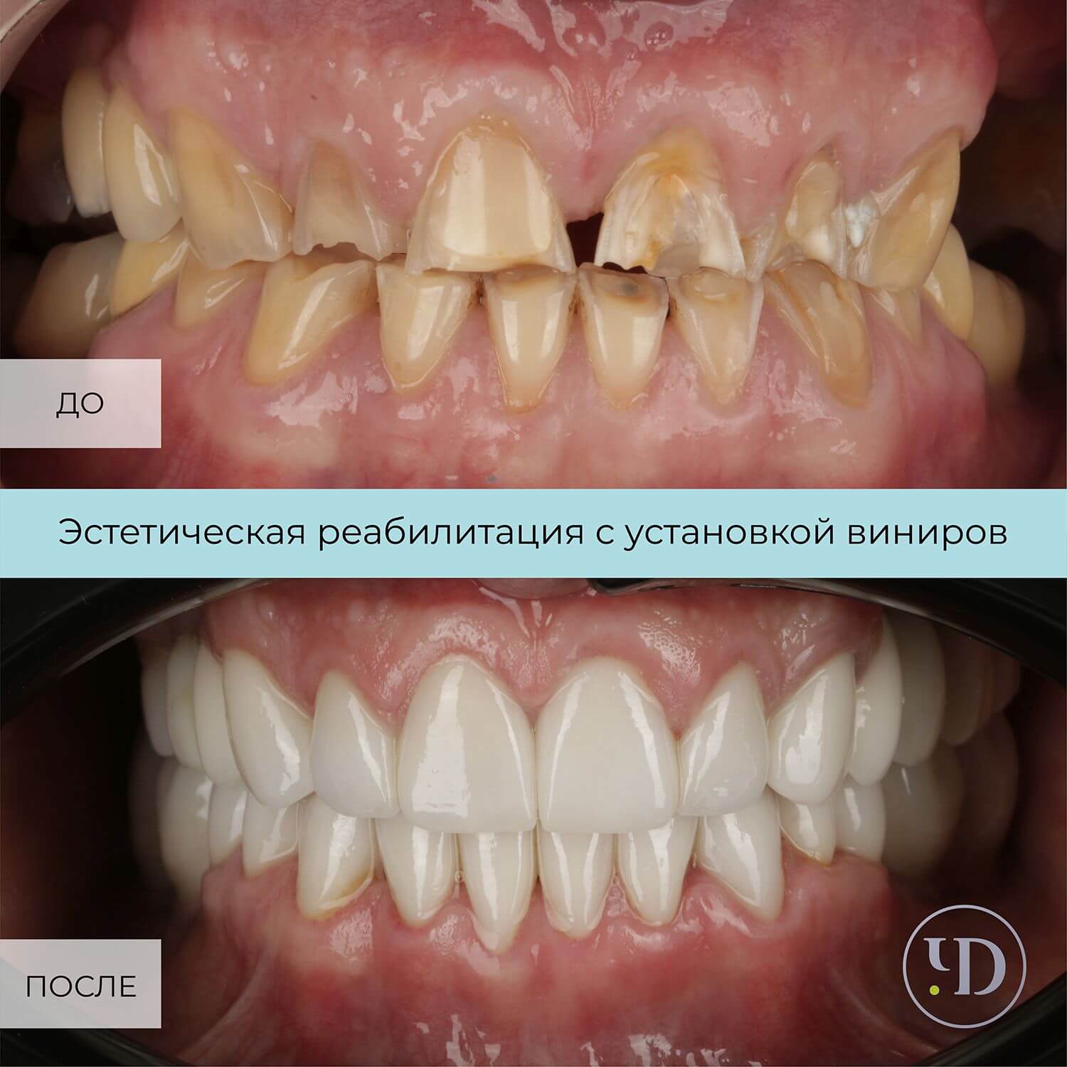 Установка виниров. Кейс 32: фото до и после | Центр стоматологии Чистое  Дыхание