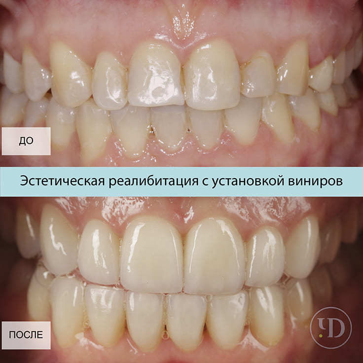 Что такое ультраниры и их отличие от люминиров?