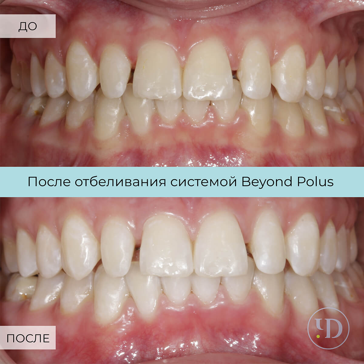 Ортокейс №5, лечение щелей между зубами — Стоматологический центр Чистое  Дыхание