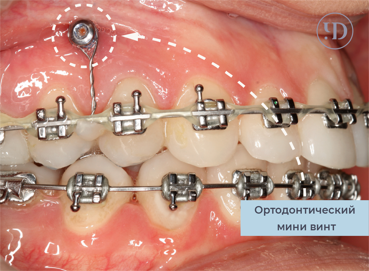 Как ставят зубные имплантаты?