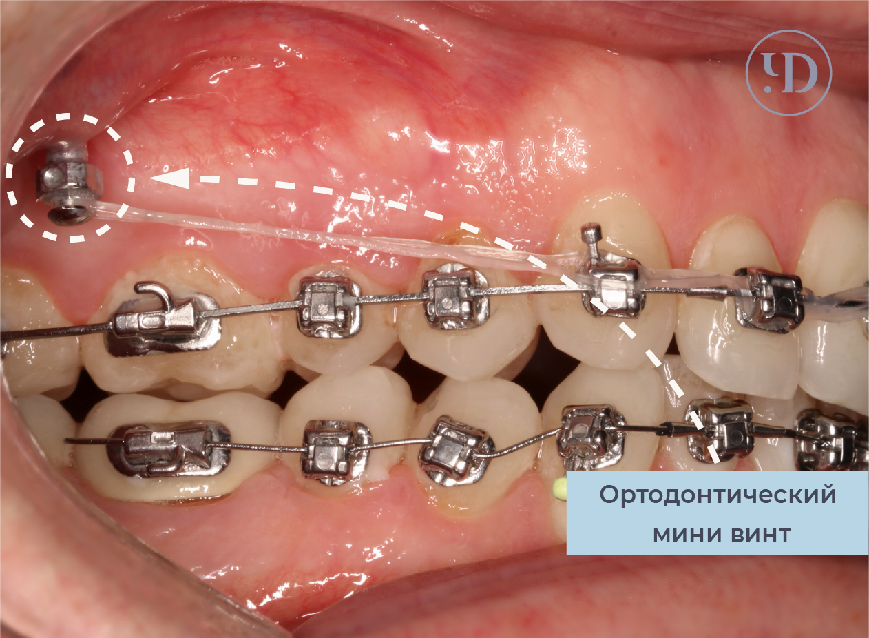Минивинты в ортодонтии