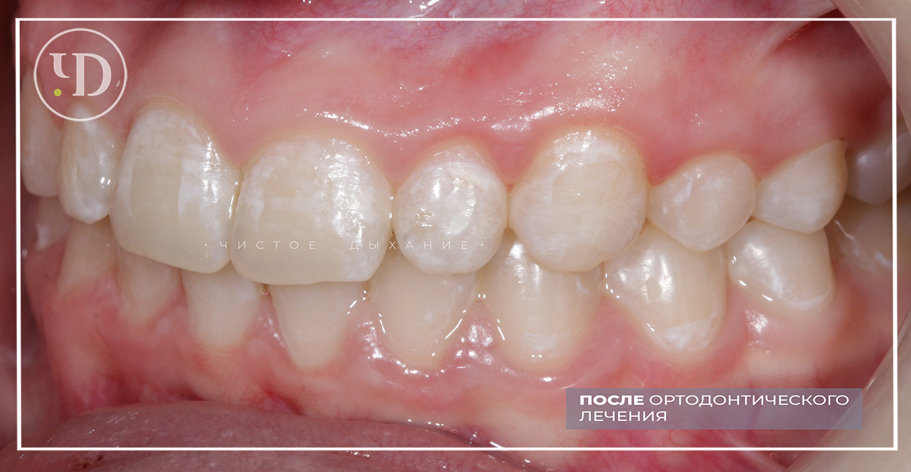 Как исправить кривые зубы: методы без брекеты, причины и способы лечения в стоматологии