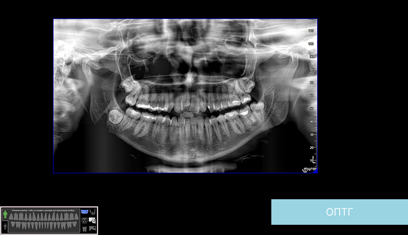 Как расшифровать рентгеновский снимок зубов