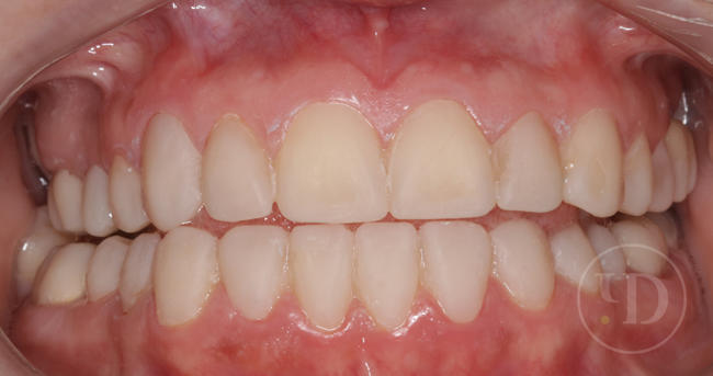 Когда требуется поставить коронку на зуб: показания к восстановлению зубов коронкой
