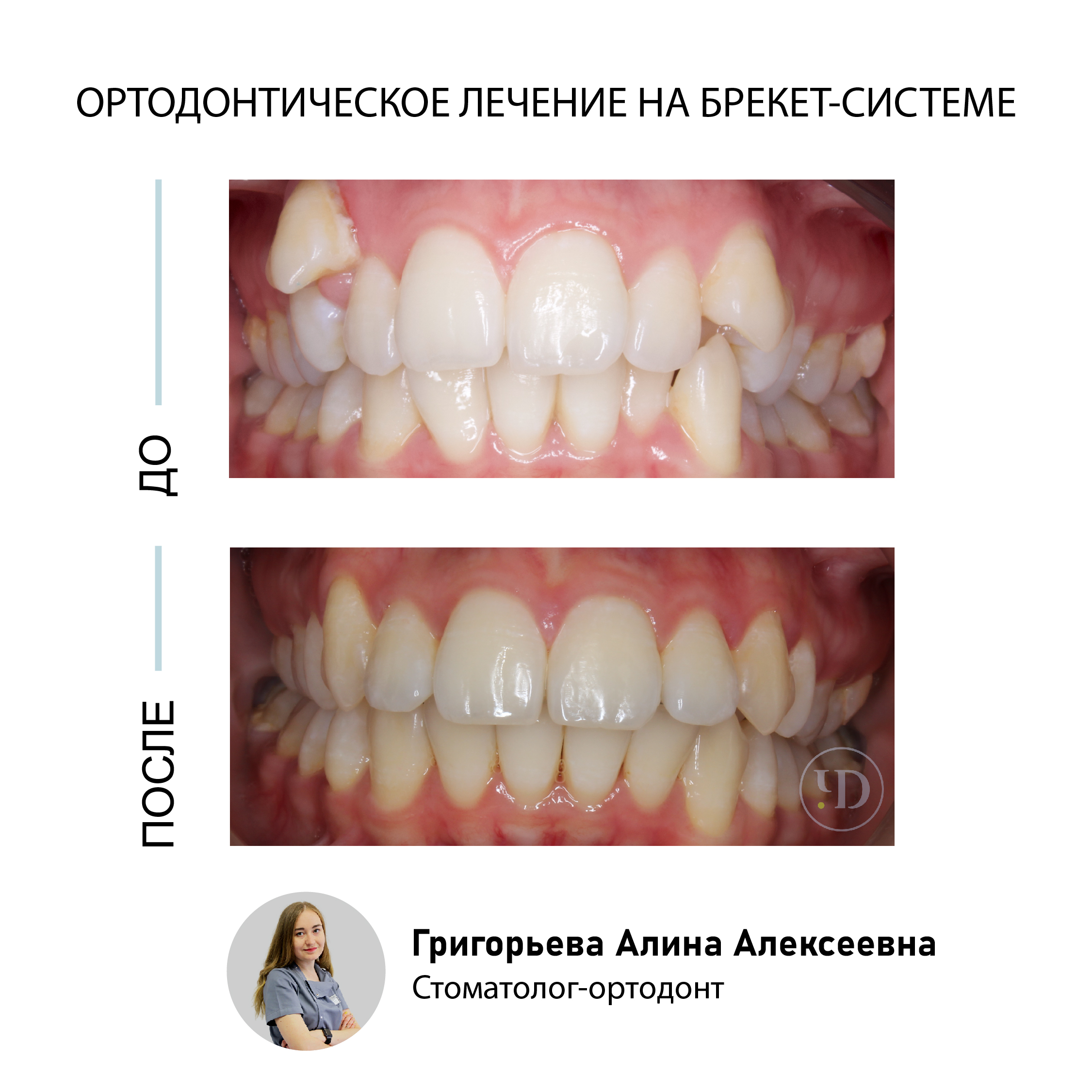 Лечение на брекет-системе. Кейс № 32 : фото до и после | Стоматология в СПб  «Чистое Дыхание»