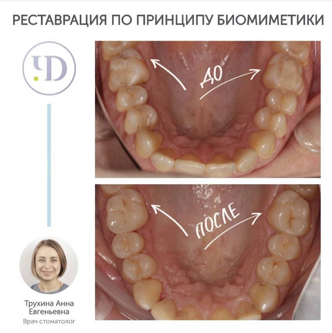 Реставрация зуба. Кейс №1, реставрация по типу биомиметики | Стоматология  «Чистое Дыхание»