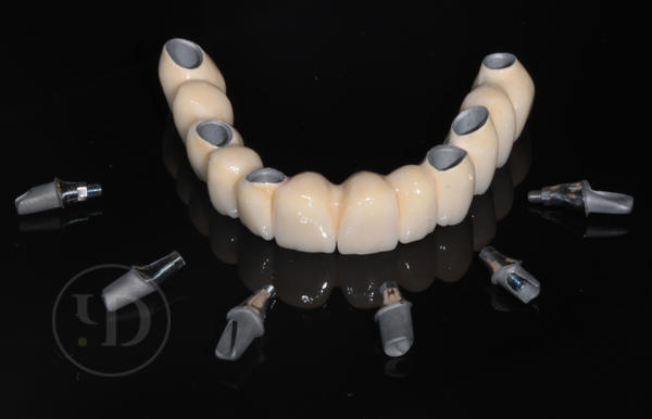 Имплантация зубов: показания и противопоказания