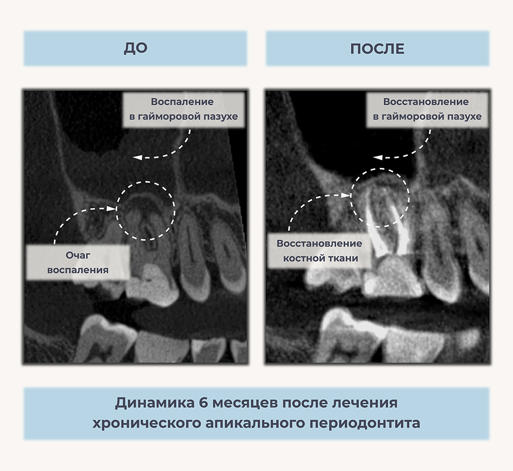 Лечение периодонтита. Кейс № 2 : фото до и после | Стоматология в СПб  «Чистое Дыхание»