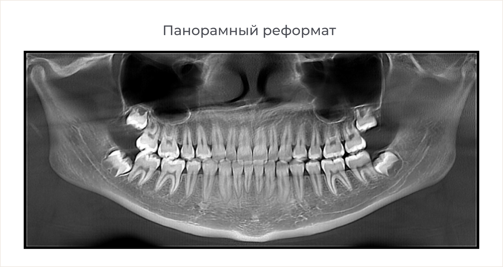 Цефалометрический анализ в ортодонтии | расчет ТРГ в боковой проекции