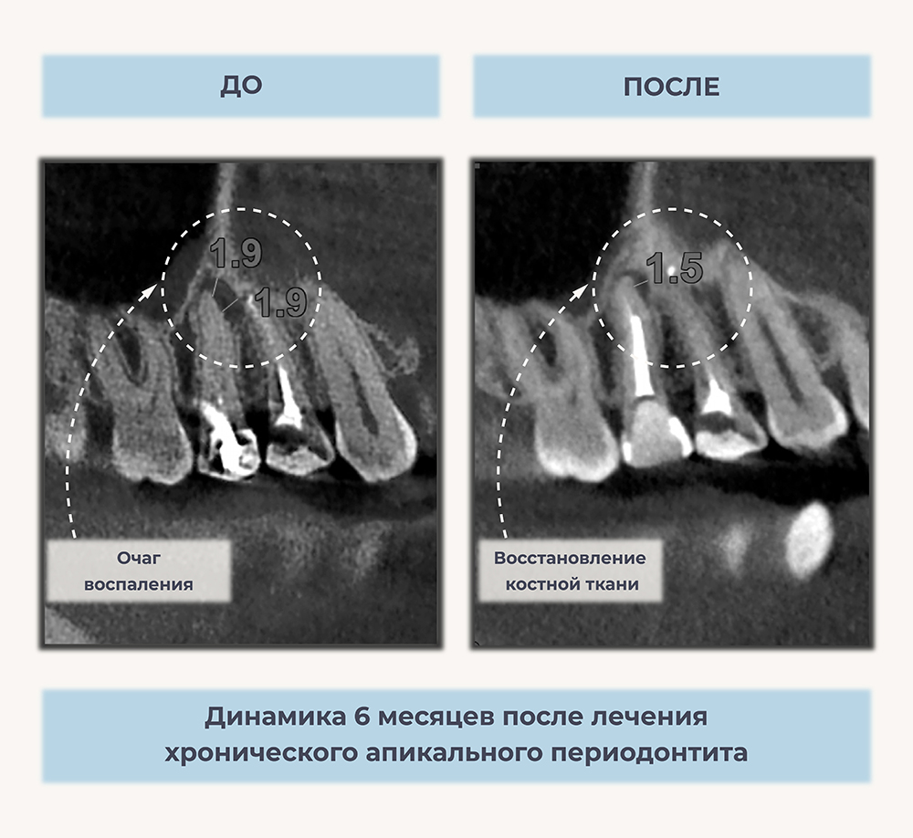 Причины периодонтита зуба