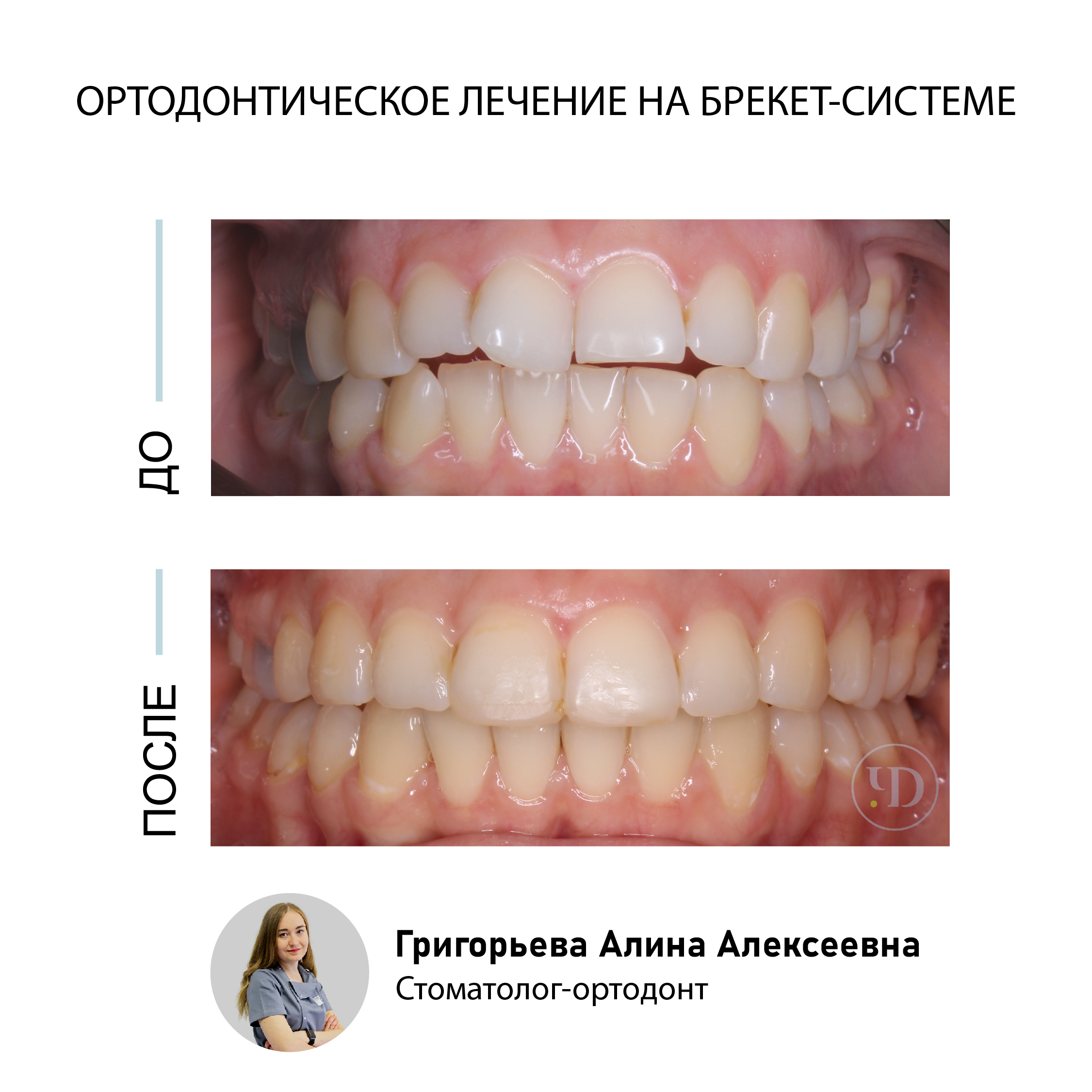 Лечение на брекет-системе. Кейс № 35 : фото до и после | Стоматология в СПб  «Чистое Дыхание»