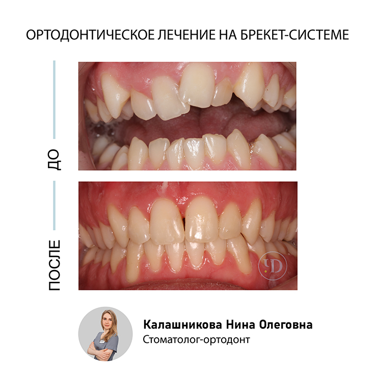 Лечение брекетами: схема, разновидности, этапы, как выбрать клинику, цены