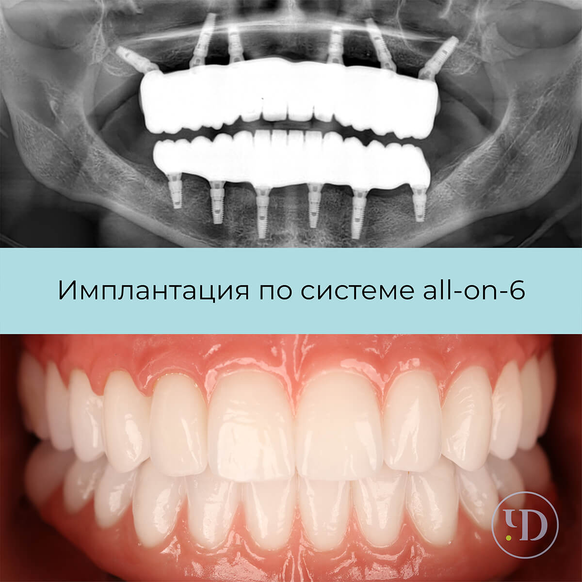 Кейс имплантации по системе all-on-6 — Стоматологические центры Чистое  Дыхание в СПб