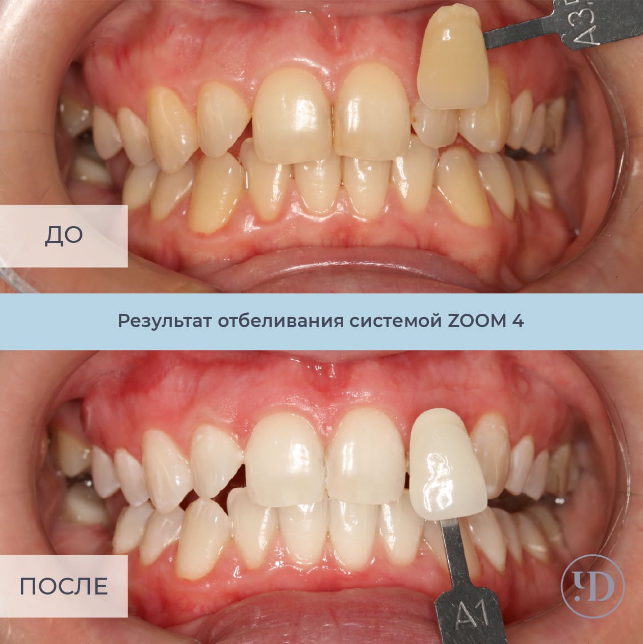 Отбеливание зубов в домашних условиях: разбор методов, их преимуществ и недостатков