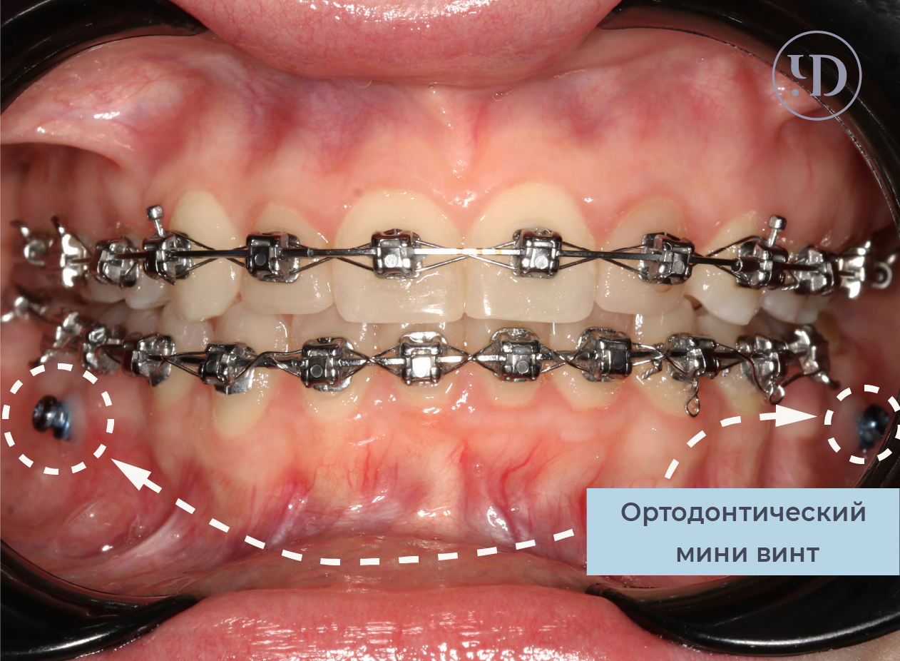 Ортодонтические мини-винты (микроимпланты) в СПб от стоматологии Чистое  Дыхание